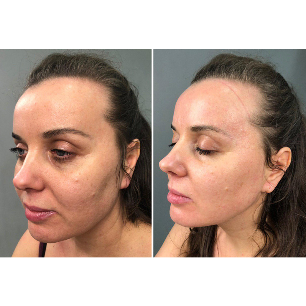 Микротоковый лифтинг-массажер MEDICA+ Skin Lifting 5.0 (Japan)