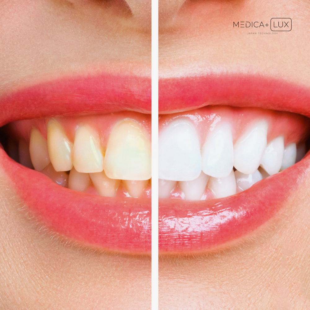 Гель для отбеливания MEDICA+ WhitePearl Pengel 3X (Japan)
