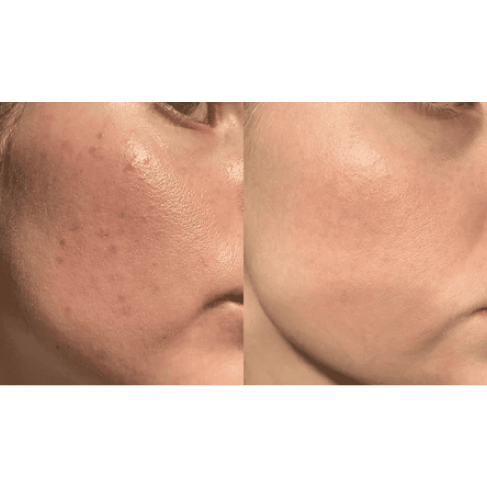 Набор Дарсонваль MEDICA+ Lux Darsoline 8.0 + суспензия Antibacterial suspension + Успокаивающая маска Soothing Mask 