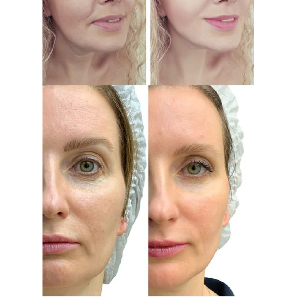 Микротоковый RF Lifting Массажер для лица Skin Lifting 7.0 Pink - EMS, LED (Japan)