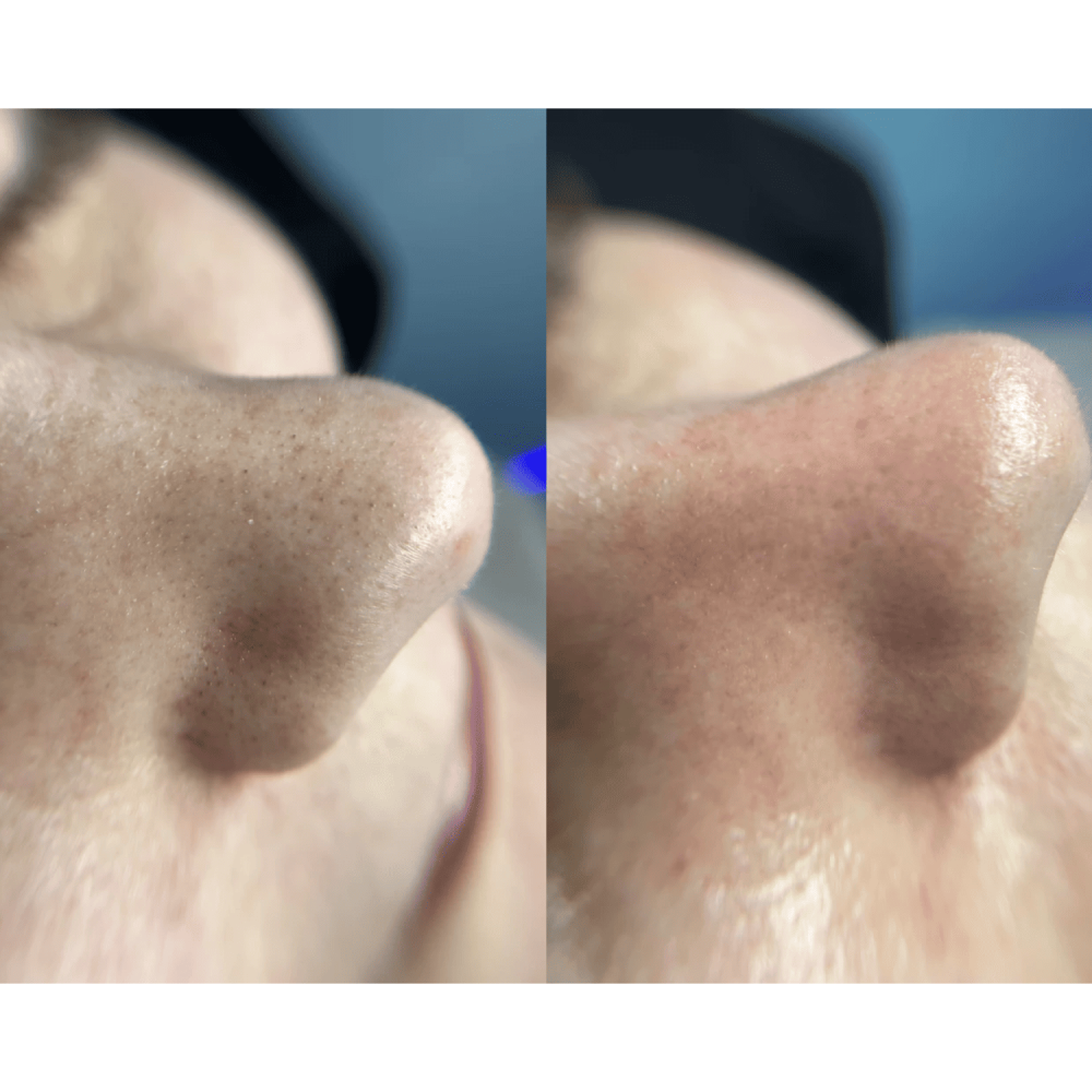 Ультразвуковой скрабер для кожи лица MEDICA+ Vibroskin 8.0 (Japan)