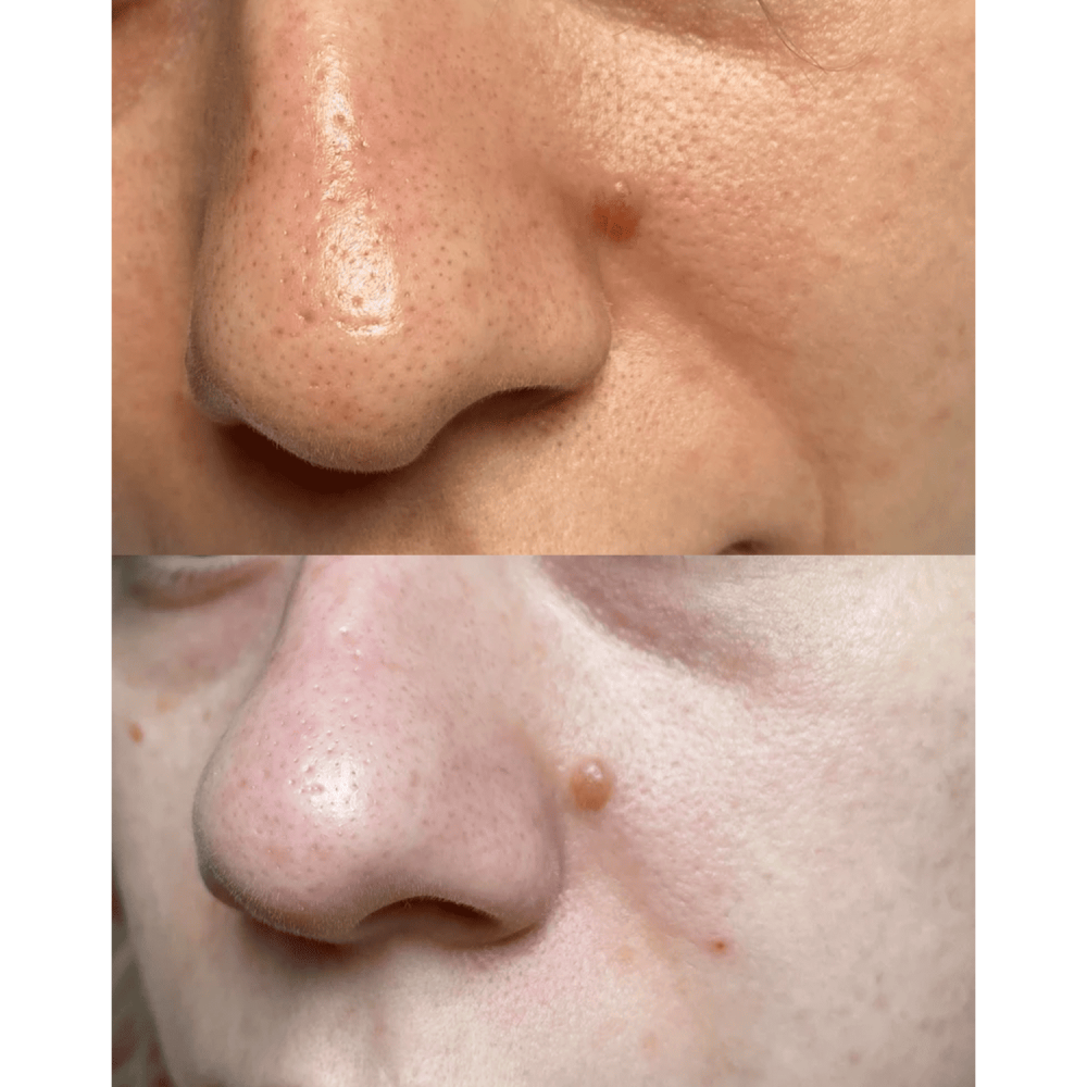 Ультразвуковой скрабер для кожи лица MEDICA+ Vibroskin 5.0 (Japan)