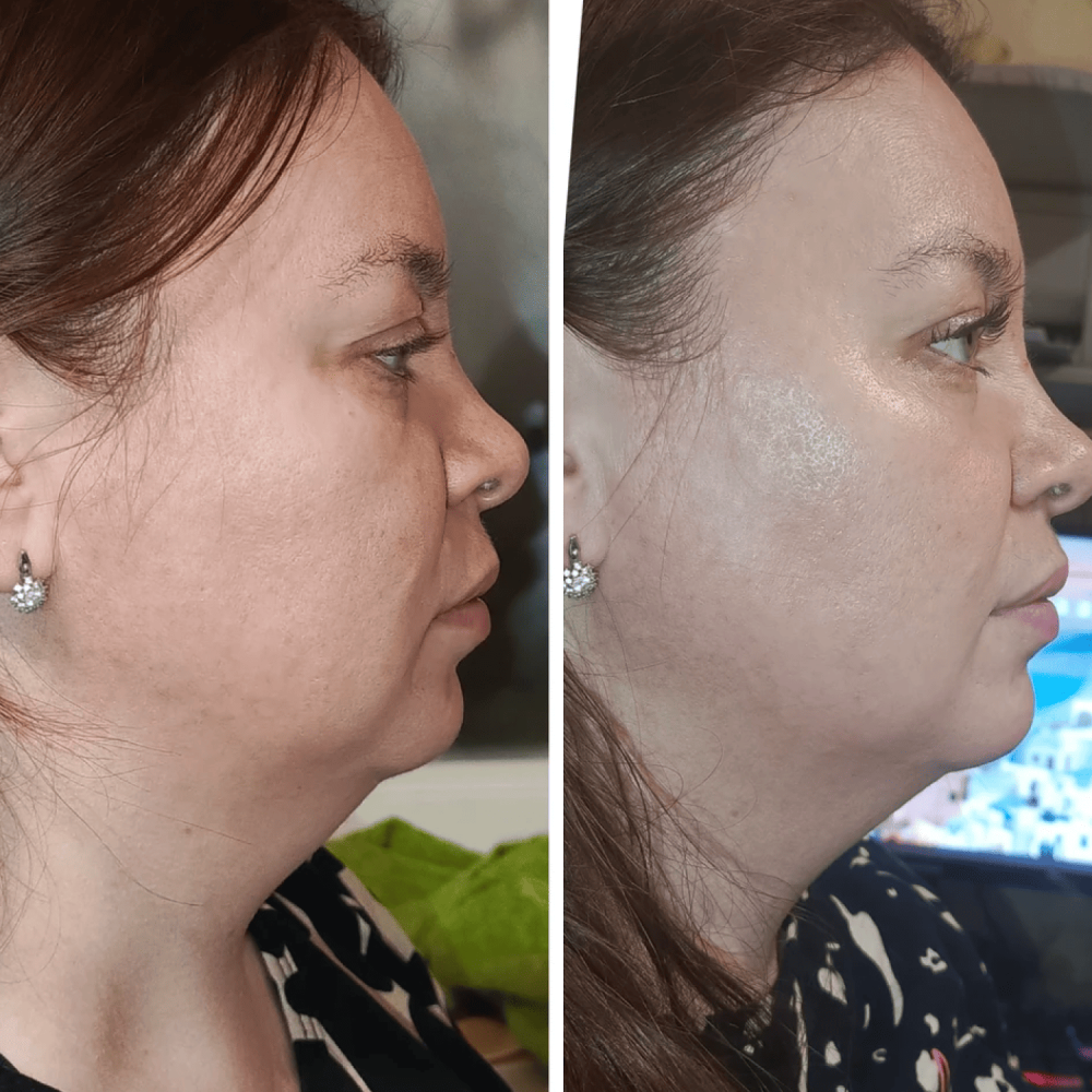 Микротоковый RF Lifting Массажер для лица Skin Lifting 7.0 Pink - EMS, LED (Japan)