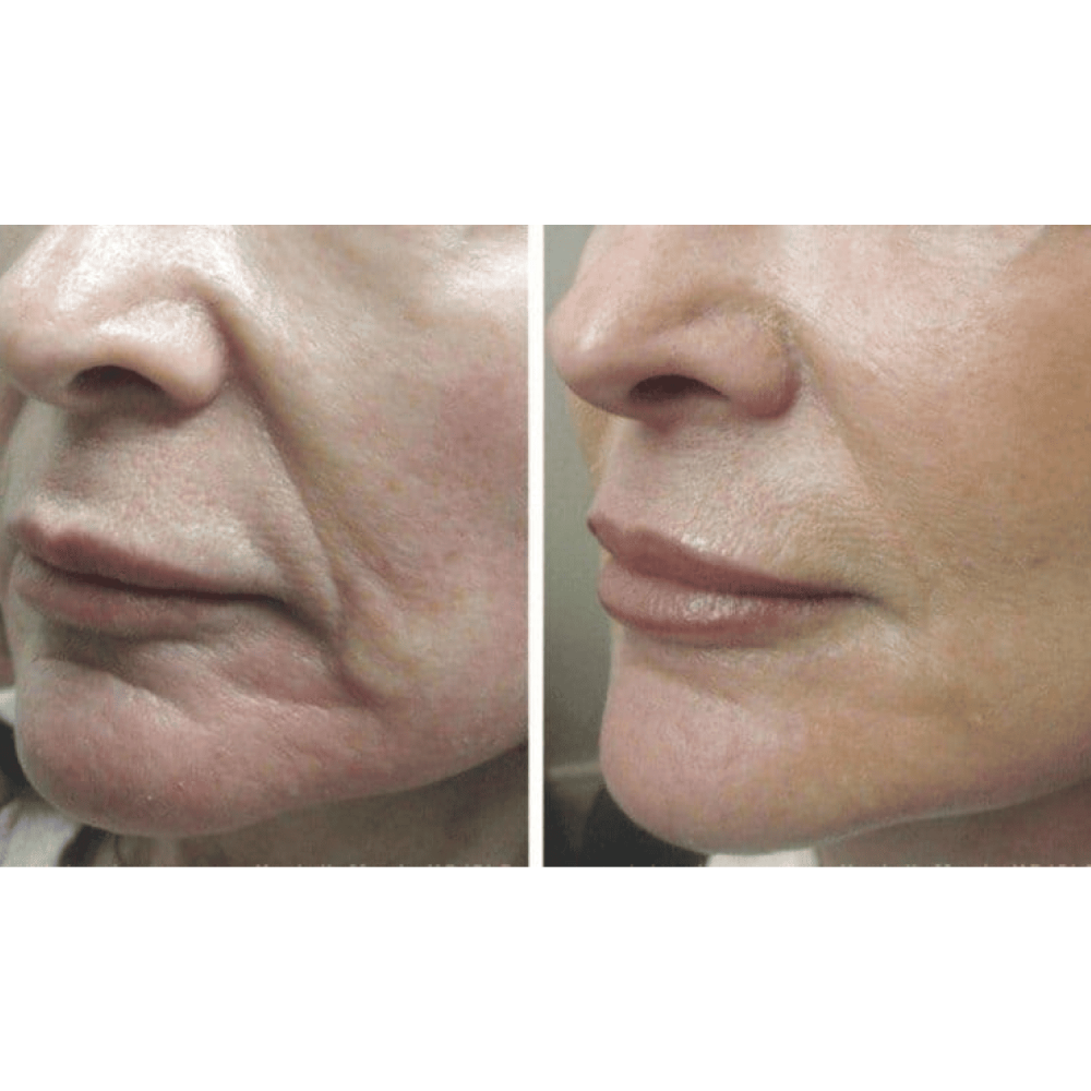 Микротоковый лифтинг-массажер MEDICA+ Skin Lifting 5.0 (Japan)