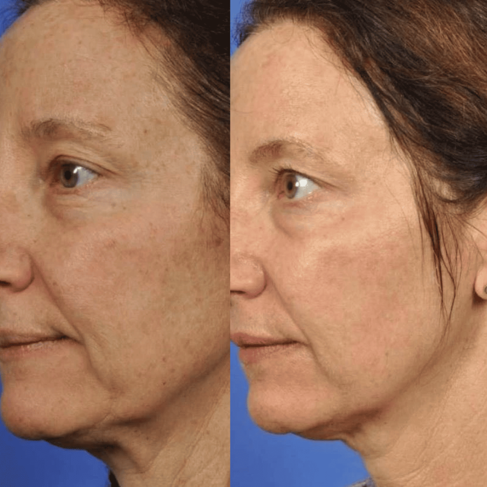 Токопроводящий гель MEDICA+ Conductive Lifting Gel (100 мл)