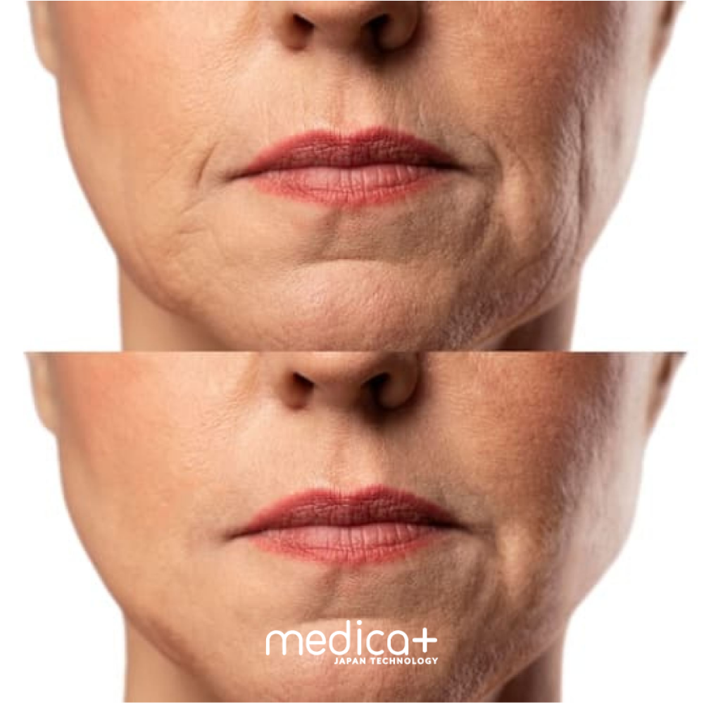 Набор Микротоковый RF Lifting Массажер для лица Skin Lifting 7.0 Pink + Токопроводящий гель + Поросужающая маска для лица MEDICA+ (Japan)